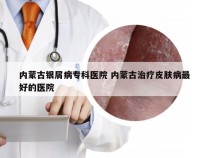 内蒙古银屑病专科医院 内蒙古治疗皮肤病最好的医院