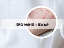 拓咨生物制剂图片 拓咨治疗