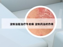 淀粉浴能治疗牛皮癣 淀粉药浴的作用
