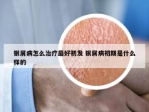 银屑病怎么治疗最好初发 银屑病初期是什么样的