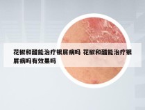 花椒和醋能治疗银屑病吗 花椒和醋能治疗银屑病吗有效果吗