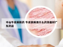 中山牛皮癣新药 牛皮肤癣用什么药膏最好广东药店