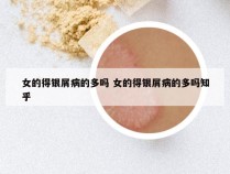 女的得银屑病的多吗 女的得银屑病的多吗知乎
