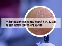 手上的银屑病能用哈西奈德溶液多久 头皮银屑病用哈西奈德时间长了副作用