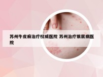 苏州牛皮癣治疗权威医院 苏州治疗银屑病医院