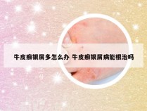 牛皮癣银屑多怎么办 牛皮癣银屑病能根治吗