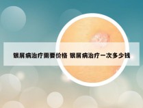 银屑病治疗需要价格 银屑病治疗一次多少钱