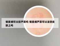 银屑病可以搽芦荟吗 银屑病芦荟可以涂到皮肤上吗