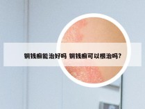 铜钱癣能治好吗 铜钱癣可以根治吗?