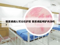 银屑病病人可以吃驴胶 银屑病能喝驴肉汤吗?