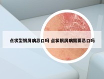 点状型银屑病忌口吗 点状银屑病需要忌口吗