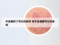 牛皮癣好了可以纹身吗 有牛皮病癣可以纹身吗