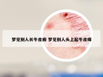 梦见别人长牛皮癣 梦见别人头上起牛皮痒