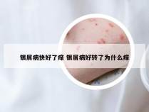 银屑病快好了痒 银屑病好转了为什么痒