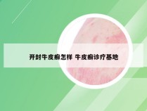 开封牛皮癣怎样 牛皮癣诊疗基地