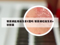 银屑病能用维生素E霜吗 银屑病吃维生素e软胶囊