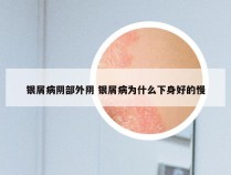 银屑病阴部外阴 银屑病为什么下身好的慢