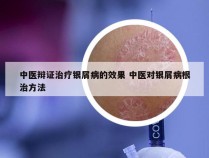 中医辩证治疗银屑病的效果 中医对银屑病根治方法