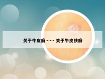 关于牛皮癣…… 关于牛皮肤癣