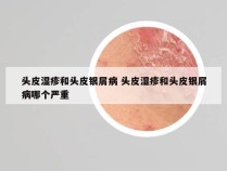 头皮湿疹和头皮银屑病 头皮湿疹和头皮银屑病哪个严重