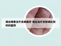 烟台哪里治牛皮癣最好 烟台治疗皮肤病比较好的医院
