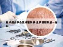 鱼鳞病会不会变成银屑病 鱼鳞病跟银屑一样吗