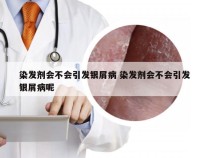 染发剂会不会引发银屑病 染发剂会不会引发银屑病呢
