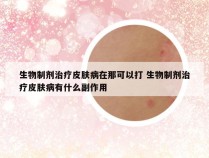 生物制剂治疗皮肤病在那可以打 生物制剂治疗皮肤病有什么副作用