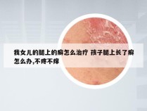 我女儿的腿上的癣怎么治疗 孩子腿上长了癣怎么办,不疼不痒