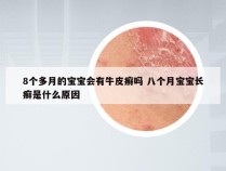 8个多月的宝宝会有牛皮癣吗 八个月宝宝长癣是什么原因
