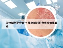 生物制剂配合光疗 生物制剂配合光疗效果好吗