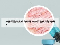 一抹灵治牛皮癣有用吗 一抹灵治皮炎管用吗?
