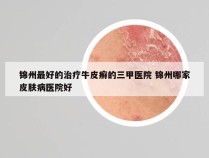 锦州最好的治疗牛皮癣的三甲医院 锦州哪家皮肤病医院好