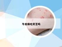 牛皮癣吃灵芝吗