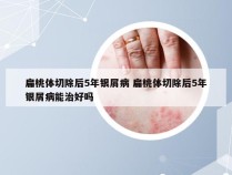 扁桃体切除后5年银屑病 扁桃体切除后5年银屑病能治好吗