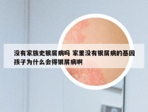 没有家族史银屑病吗 家里没有银屑病的基因孩子为什么会得银屑病啊