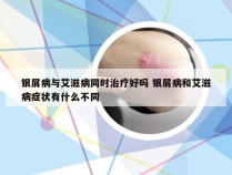 银屑病与艾滋病同时治疗好吗 银屑病和艾滋病症状有什么不同