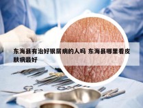 东海县有治好银屑病的人吗 东海县哪里看皮肤病最好
