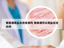 银屑病用盐水洗有用吗 银屑病可以用盐水洗头吗