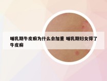 哺乳期牛皮癣为什么会加重 哺乳期妇女得了牛皮癣