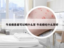 牛皮癣患者可以喝什么茶 牛皮癣吃什么茶好