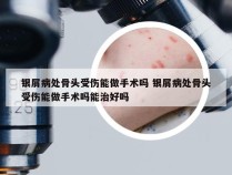 银屑病处骨头受伤能做手术吗 银屑病处骨头受伤能做手术吗能治好吗