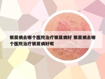 银屑病去哪个医院治疗银屑病好 银屑病去哪个医院治疗银屑病好呢