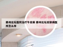 滕州北坛医院治疗牛皮癣 滕州北坛皮肤病医院怎么样