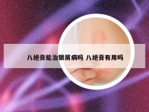 八绝膏能治银屑病吗 八绝膏有用吗