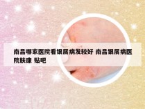 南昌哪家医院看银屑病发较好 南昌银屑病医院肤康 贴吧