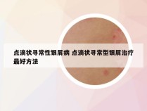 点滴状寻常性银屑病 点滴状寻常型银屑治疗最好方法