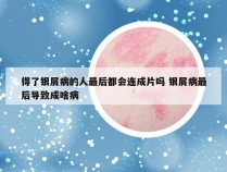 得了银屑病的人最后都会连成片吗 银屑病最后导致成啥病