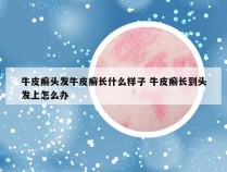 牛皮癣头发牛皮癣长什么样子 牛皮癣长到头发上怎么办