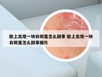 脸上出现一块白斑是怎么回事 脸上出现一块白斑是怎么回事图片